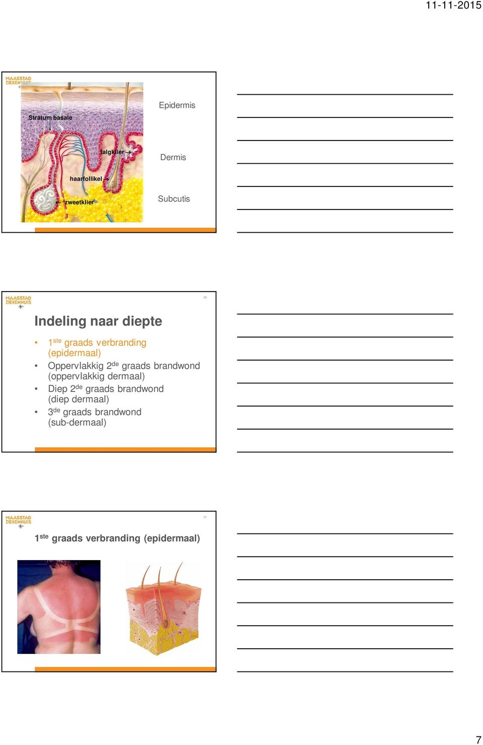 graads brandwond (oppervlakkig dermaal) Diep 2 de graads brandwond (diep