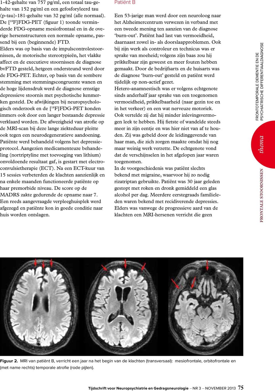 Elders was op basis van de impulscontrolestoornissen, de motorische stereotypieën, het vlakke affect en de executieve stoornissen de diagnose bvftd gesteld, hetgeen ondersteund werd door de FDG-PET.