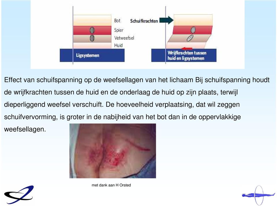 dieperliggend weefsel verschuift.