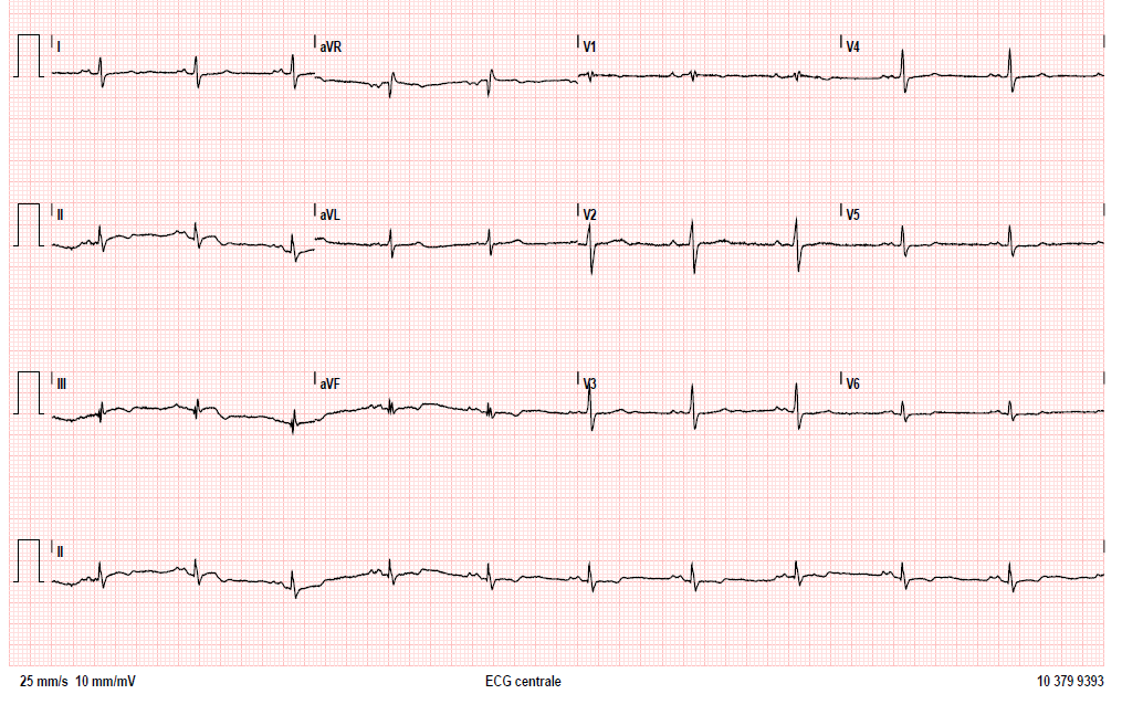 ECG