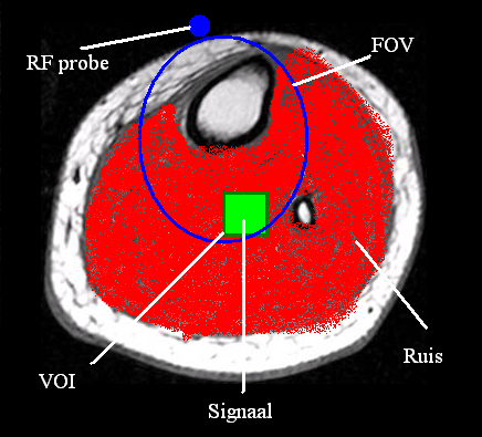 Hoofdstuk 2.RF spoel theorie 27 (a) Achter de tong (b) Op het bot Figuur 2.1: Optimale dimensionering en positionering van een RF probe de larmorfrequentie. Daaruit valt o.a. af te leiden dat huid,(nek)spier, hersenweefsel en zenuwen veel beter geleiden dan vet en bot.
