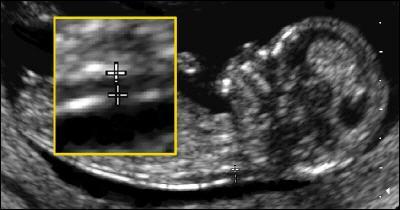 Prenataal onderzoek Echo