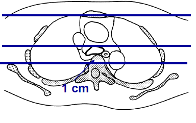 te wijten aan aanwezigheid lucht tss vss mediastinale structuren kan optreden bij trauma: trachea- of bronchusruptuur, ribfractuur met longperforatie mediastinitis: ontsteking met spontane gasvorming