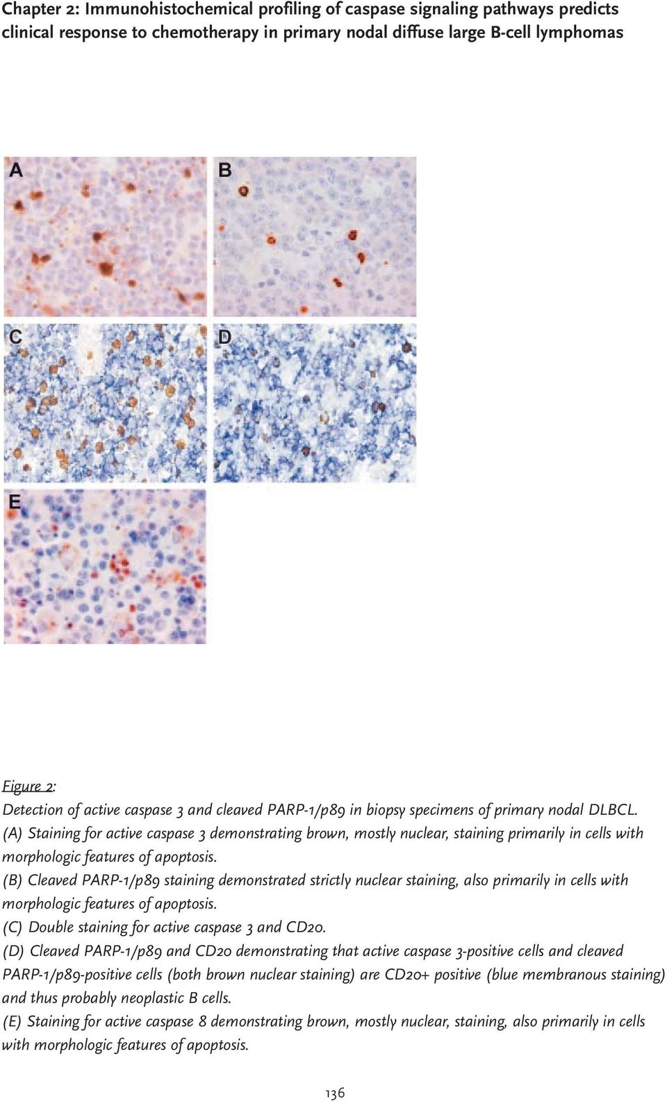 (A) Staining for active caspase 3 demonstrating brown, mostly nuclear, staining primarily in cells with morphologic features of apoptosis.