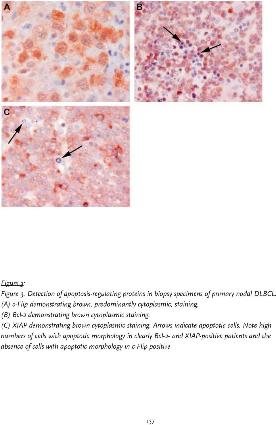 (C) XIAP demonstrating brown cytoplasmic staining. Arrows indicate apoptotic cells.