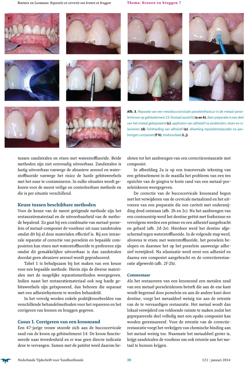 appliceren van adhesief na zandstralen, etsen en silaniseren (d); lichtharding van adhesief (e); afwerking reparatierestauratie na aanbrengen composiet (f-h); eindresultaat (i, j).