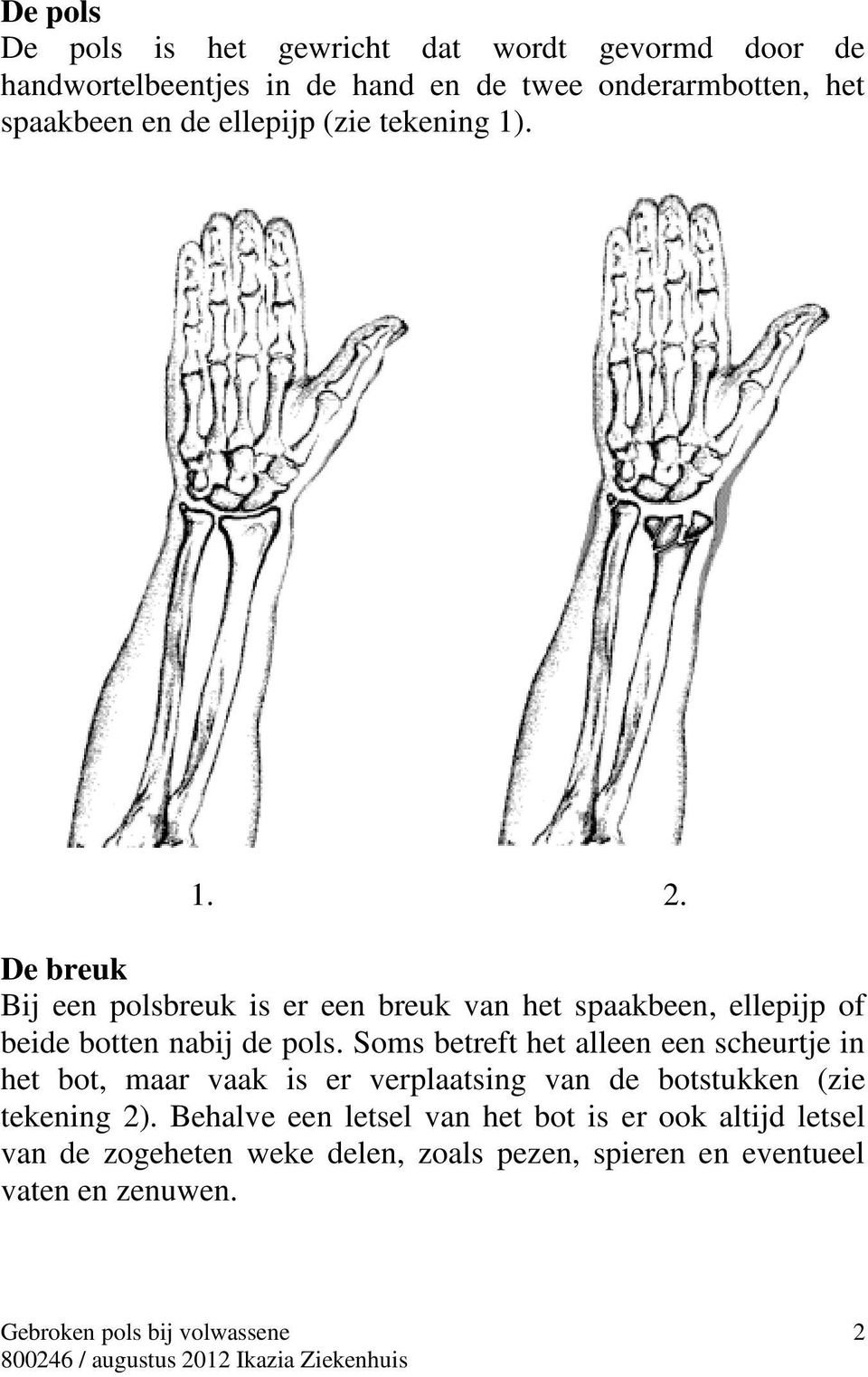 De breuk Bij een polsbreuk is er een breuk van het spaakbeen, ellepijp of beide botten nabij de pols.