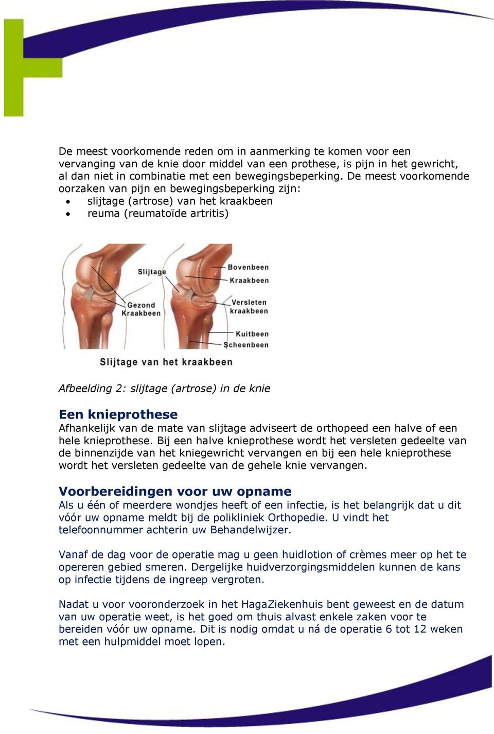 Afhankelijk van de mate van slijtage adviseert de orthopeed een halve of een hele knieprothese.