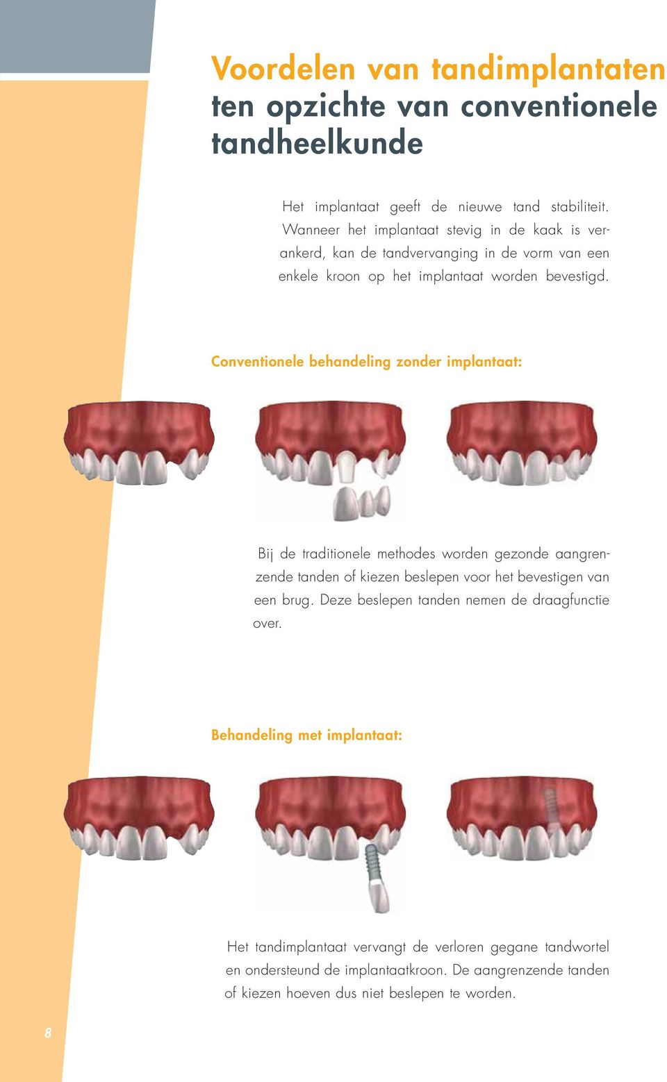 Conventionele behandeling zonder implantaat: Bij de traditionele methodes worden gezonde aangrenzende tanden of kiezen beslepen voor het bevestigen van een brug.
