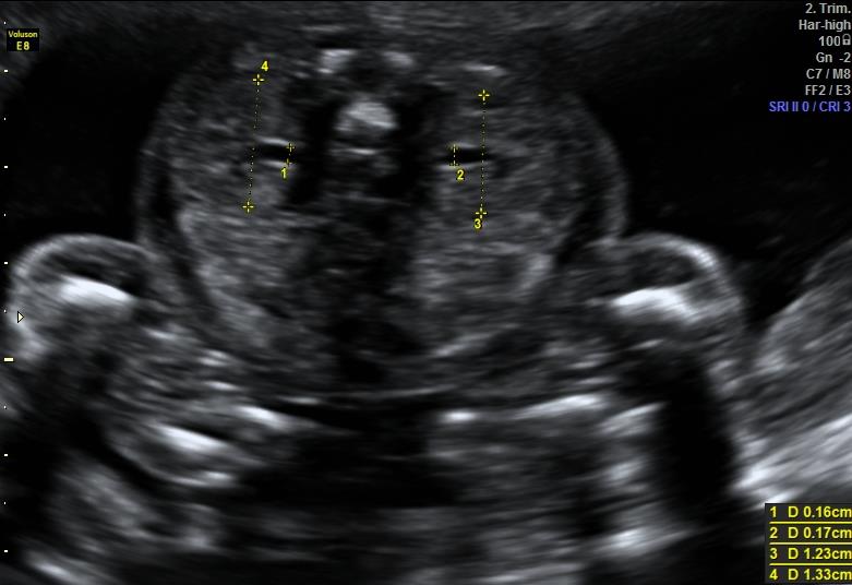 Abdomen Pyelum, nierparenchym rechts en links Doorsnede voldoet aan: transversaal (niet schuin), beide nieren in beeld.