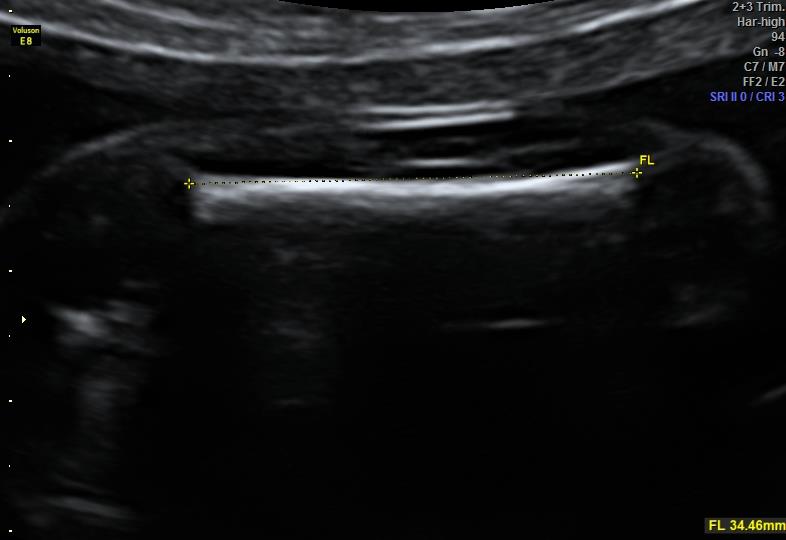 Biometrie FL Doorsnede voldoet aan: huidlijn van bovenbeen parallel aan het femur, goed afgrensbaar, femur
