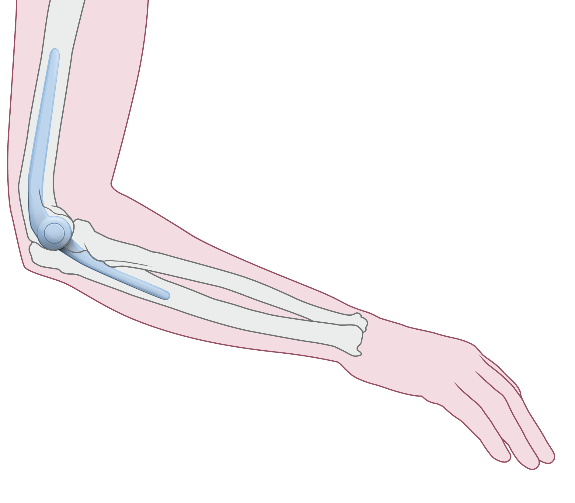 Soorten protheses Onderdelen Een elleboogprothese bestaat uit 2 onderdelen: een bovenarmdeel en een ellepijpdeel. Deze 2 onderdelen scharnieren ten opzichte van elkaar.