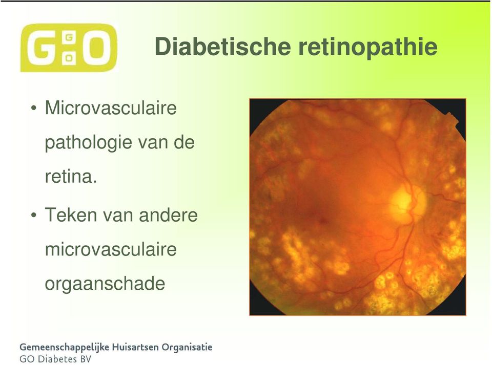 van de retina.