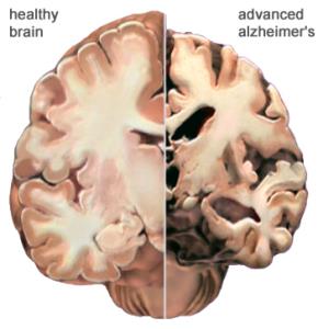 Door de dementie raken de uiteinden van de hersens zenuwen beschadigt, hierdoor worden er geen signalen meer overgebracht naar de andere zenuwen.