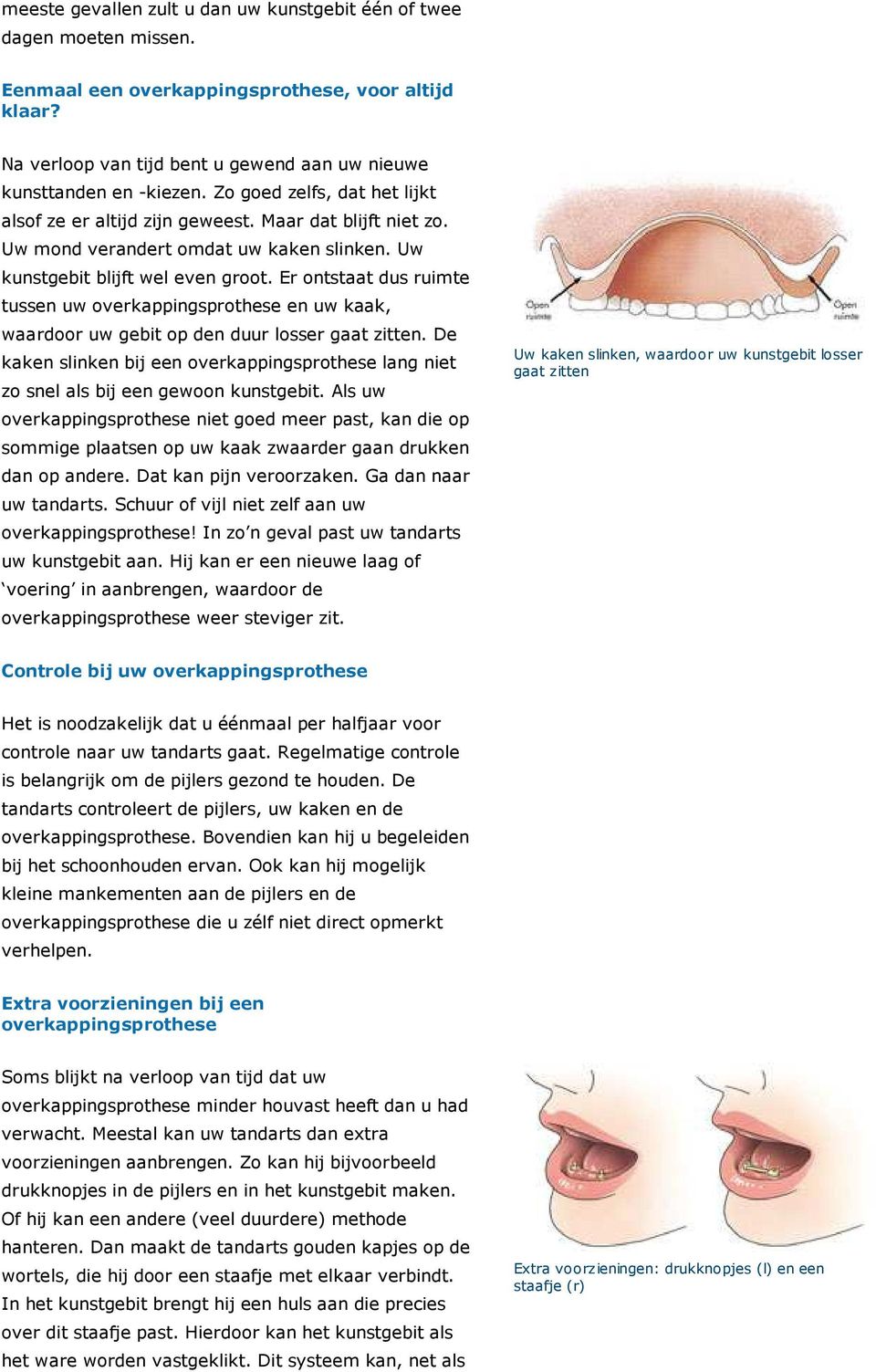 Er ontstaat dus ruimte tussen uw overkappingsprothese en uw kaak, waardoor uw gebit op den duur losser gaat zitten.