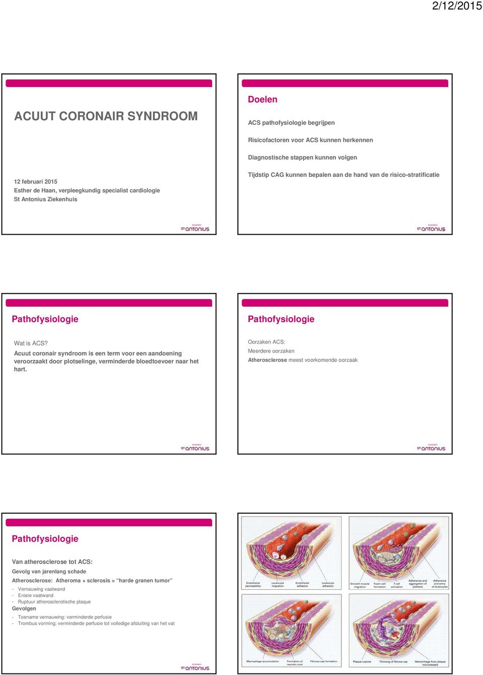 Acuut coronair syndroom is een term voor een aandoening veroorzaakt door plotselinge, verminderde bloedtoevoer naar het hart.