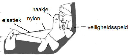 Afb. 1 Kleinert spalk Als het hechten van de pees niet meer mogelijk is Soms komt het voor dat de peesuiteinden zich hebben teruggetrokken. Ze zijn dan niet meer te hechten.