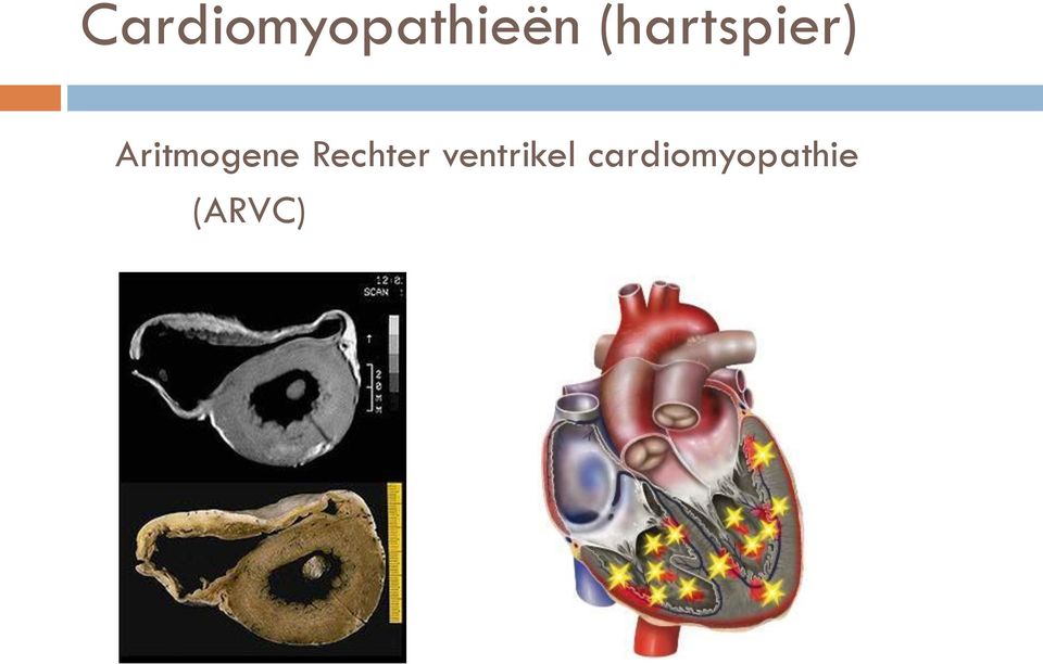 Aritmogene Rechter