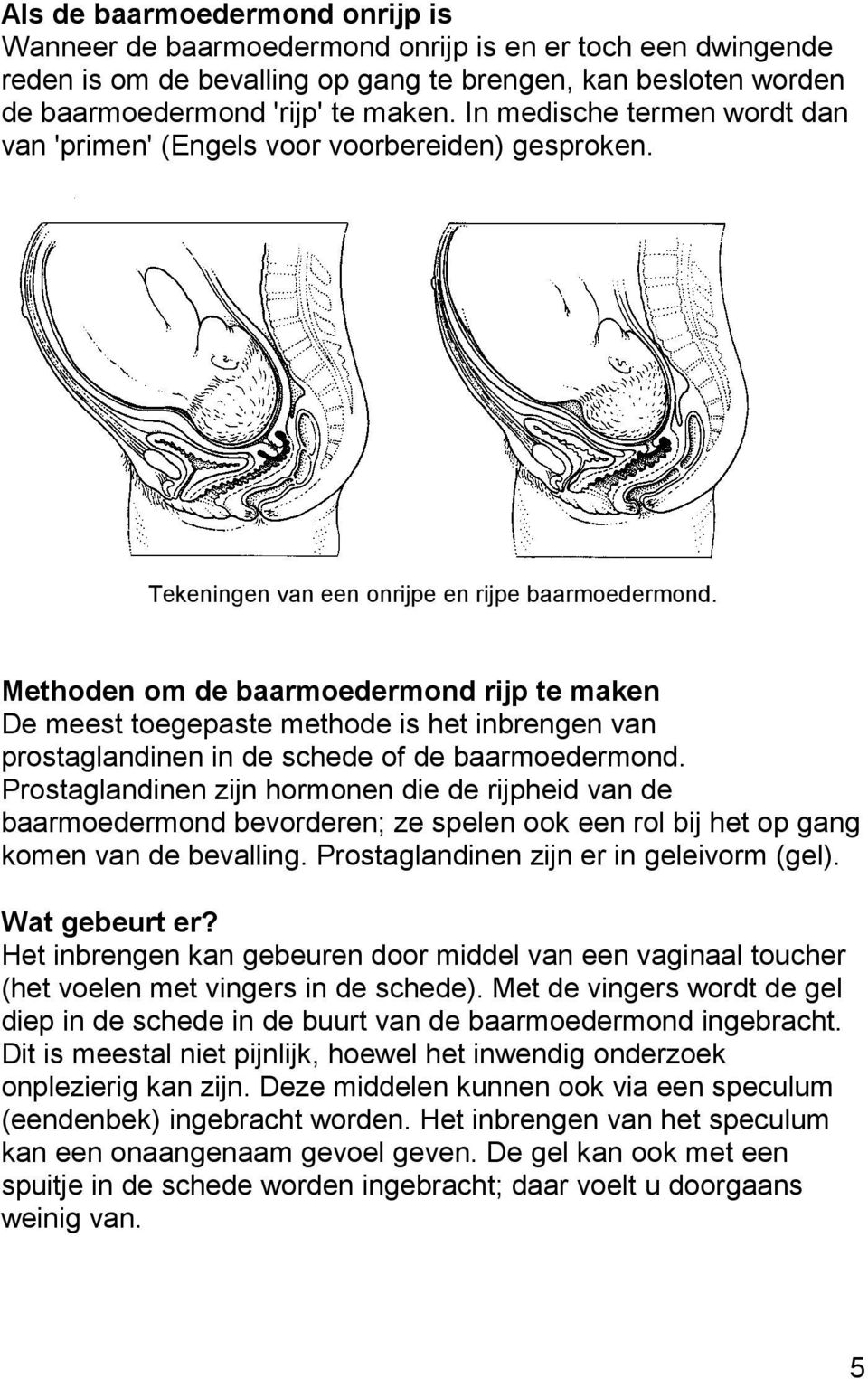 Methoden om de baarmoedermond rijp te maken De meest toegepaste methode is het inbrengen van prostaglandinen in de schede of de baarmoedermond.