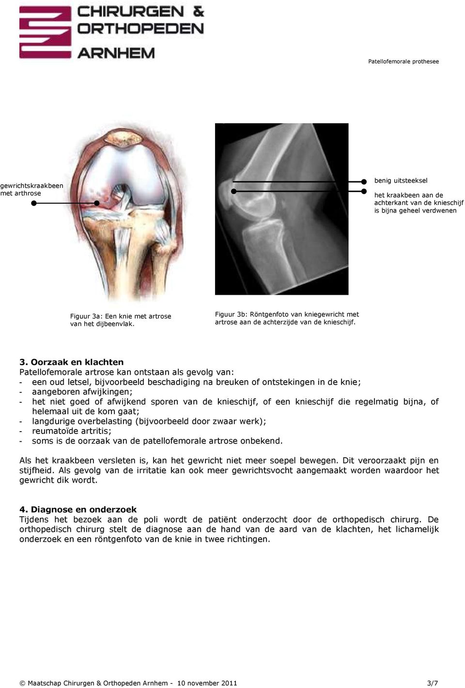 : Röntgenfoto van kniegewricht met artrose aan de achterzijde van de knieschijf. 3.