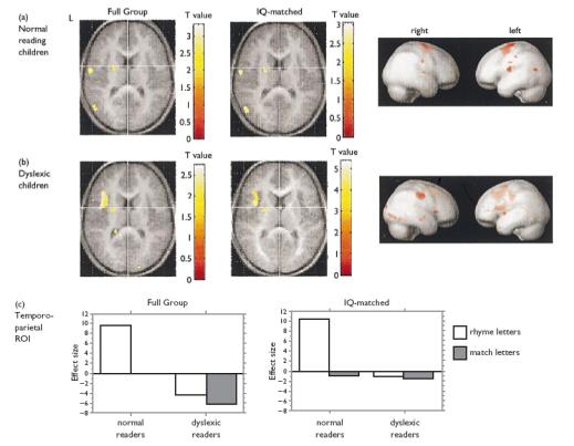 Diffusion Tracking Imaging DTI R Sun et al, Ped Neonatol 2010 Dyslexia : Core