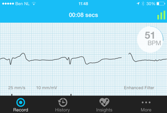 Home monitoring: AliveCor Lau et al.