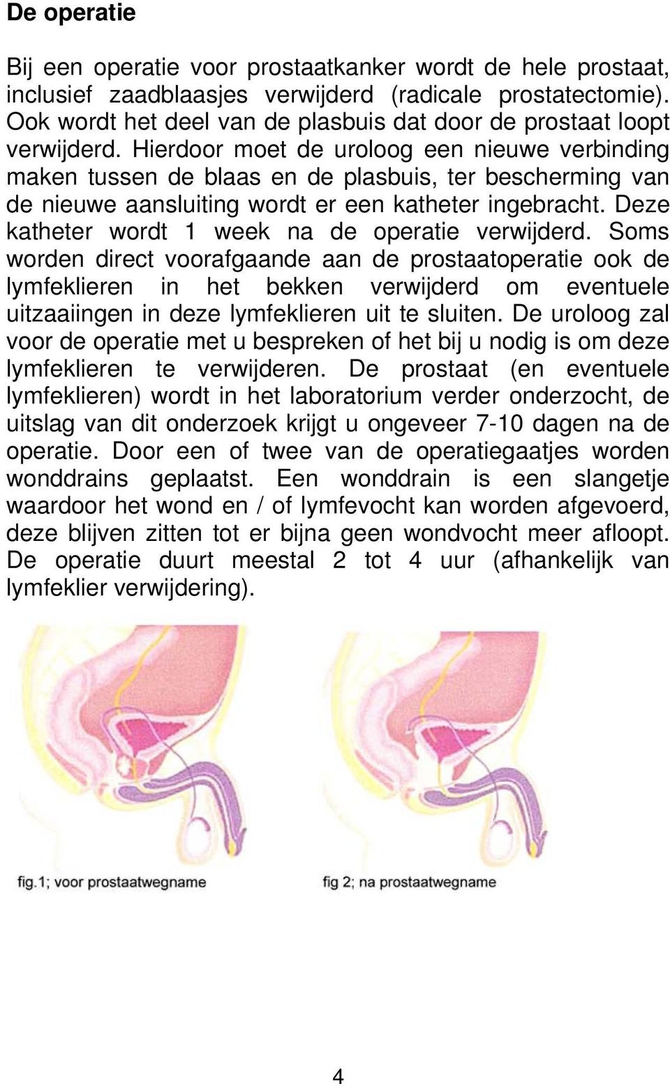 Hierdoor moet de uroloog een nieuwe verbinding maken tussen de blaas en de plasbuis, ter bescherming van de nieuwe aansluiting wordt er een katheter ingebracht.