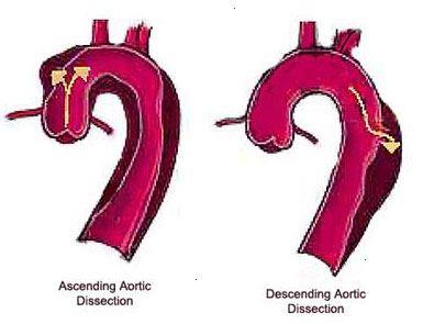 Bij een aortadissectie zit er een scheur in de binnenwand van de aorta. Een aneurysma met dissectie geeft vaak aanhoudende heftige pijn in de borstkas of tussen de schouderbladen.