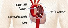 Wat is een aortadissectie? Dissectie betekent splijting. Bij een dissectie, of splijting, van een slagader raken de binnen- en buitenwand gescheiden.
