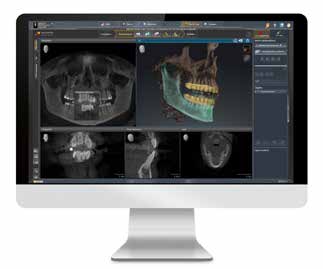 APPARATUUR SIRONA SOFTWARE CEREC ORTHO snellere start met alignerbehandelingen Met de CEREC Ortho software 1.1 worden de digitale modellen vertaald naar Aligner Technology toepassingen.