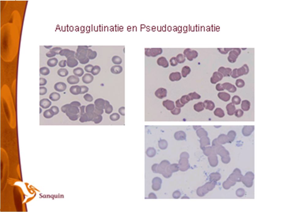 Serologisch onderzoek; transfusievraag Onderzoek erytrocyten; agglutinatie in de buis auto of pseudo agglutinatie?