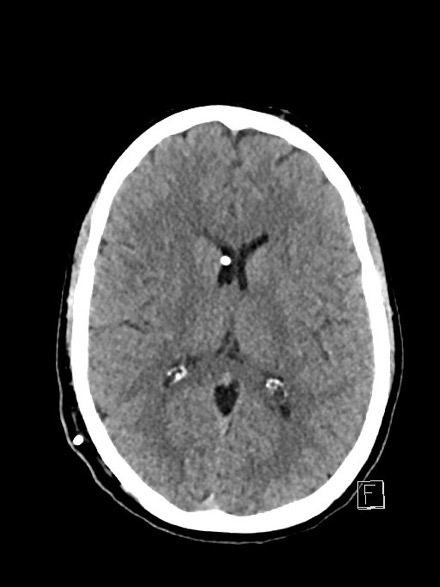 Behandeling : specifiek specifiek (bovenop algemene maatregelen; neuro-intensieve zorgen vereist) diepe sedatie externe ventriculaire drainage (EVD)