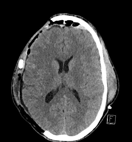 Behandeling : refractaire ICP stijging Barbituraat coma (cave: cardiovasculaire effecten) Doorgedreven Hyperventilatie (tot PaCO2