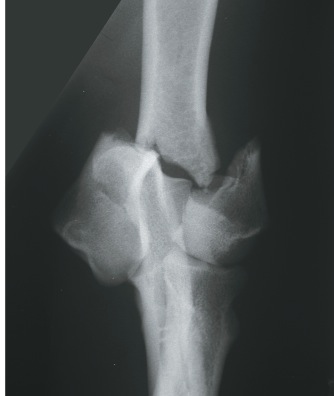 dicondylaire of bicondylaire fracturen (McKee et al., 2005). Intercondylaire fracturen kunnen nog verder onderverdeeld worden in vijf types (Fig. 13).