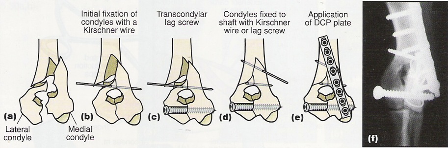Nog een andere methode bestaat uit het invoeren van twee flexibele intramedullaire pinnen met kleine diameter langs de caudolaterale en caudomediale oppervlakten van de condyl om de fractuurlijn te