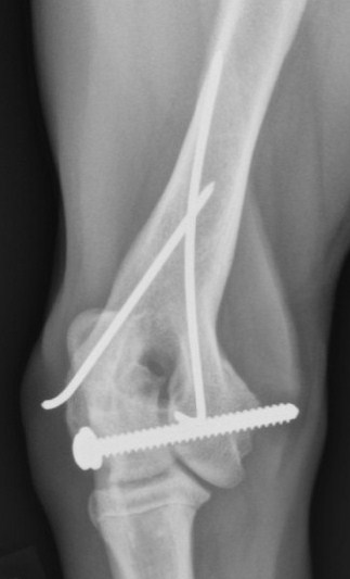 hoogte van de humerus was geen fractuurlijn meer zichtbaar. Er werd geconcludeerd dat de fractuur geheeld was.