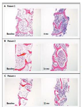 and Improved Hematopoiesis in Refractory