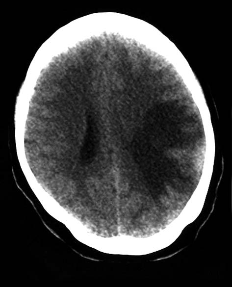 Figuur 1. CT-scan van de hersenen van de patiënte. Op de uit Suriname afkomstige scan is met name pariëtaal vingervormig oedeem zichtbaar en massawerking op zijventrikel/achterhoorn links.