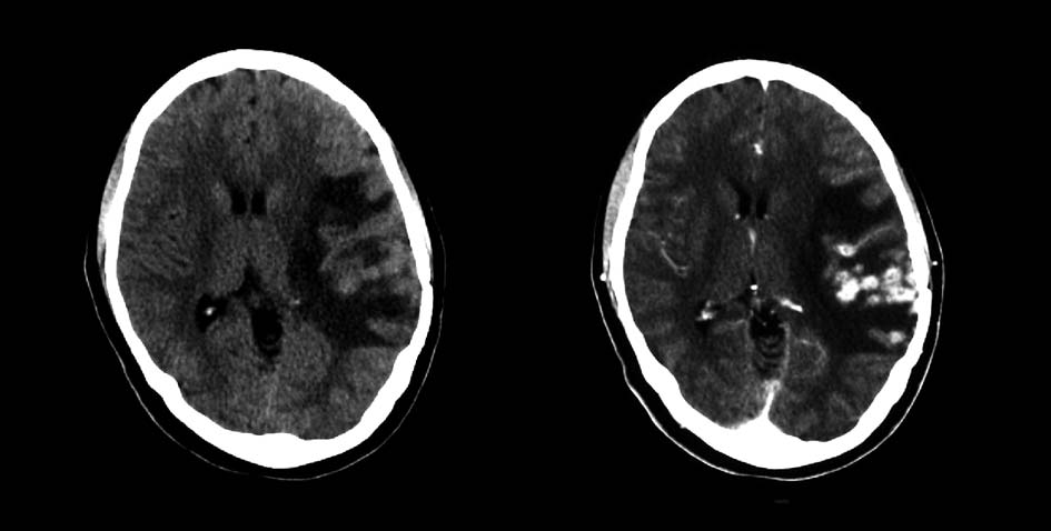 A B Figuur 4. CT-scans van de hersenen van de patiënte, anderhalf jaar na de initiële klachten. A. Met name links pariëtaal is oedeem met massawerking zichtbaar. B. Na toediening van contrast is felle aankleuring, met name corticaal, zichtbaar.