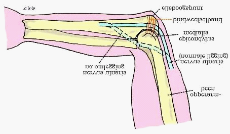 Sulcus nervi ulnaris syndroom Onder ulnaris neuropathie, cubitale tunnel syndroom of sulcus nervi ulnaris syndroom wordt een aandoening van een van de drie armzenuwen, de nervus ulnaris of