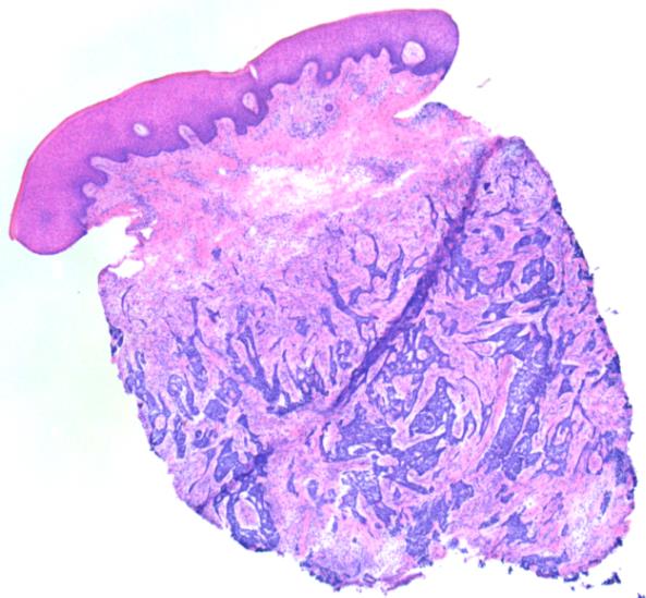 Targeted therapy voor basaalcelcarcinomen Oncologiesymposium Maastricht 28.01.