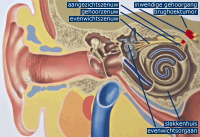 Inleiding Uw KNO-arts heeft een zelfdzame afwijking, een brughoektumor bij u vastgesteld. In deze folder geven we u informatie over deze afwijking en hoe deze behandeld kan worden.