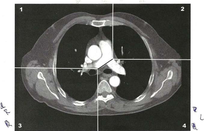 Antwoordopties: A. a. pulmonalis rechts B. a. pulmonalis links C. aorta ascendens D. aorta descendens E. atrium rechts F. atrium links 7 crus van het diafragma H. diafragma rechts I.