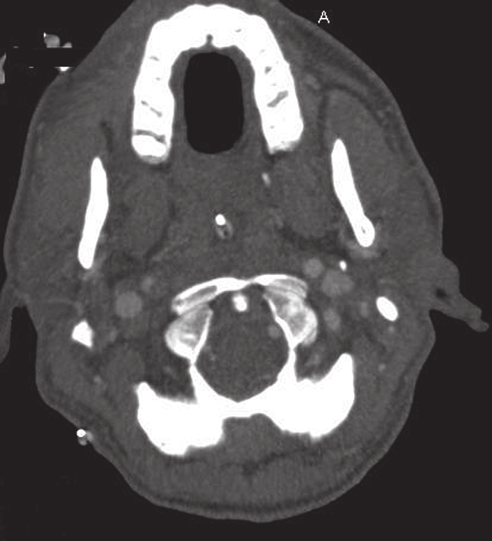 figuur 2. CT-scan van het cerebrum van patiënt B, waarop een groot infarct zichtbaar is van het verzorgingsgebied van de rechter A. cerebri media. R L R L externa interna figuur 3.