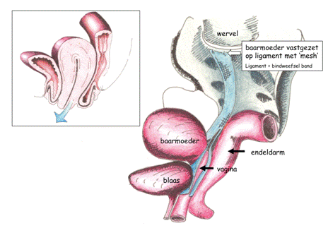 Ophangen van de verzakte vaginatop Ophangen van de verzakte baarmoeder met mesh Hoe effectief is de operatie?