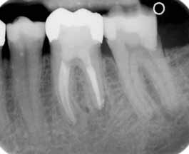 Casus Verwijdering zilverstift en Thermafil Een patiënt is verwezen door zijn eigen tandarts, gelukkig zonder klachten, maar wel met een probleem.