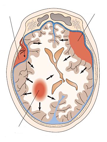 Epiduraal hematoom Subduraal