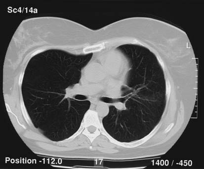 65-Chirurgie 28.4 01-06-2005 11:28 Pagina 521 28.4 INCIDENTALOMEN 521 Kernpunten Bij incidenteel gevonden longmetastasen staat de vraag centraal of het operabele longmetastasen betreft.