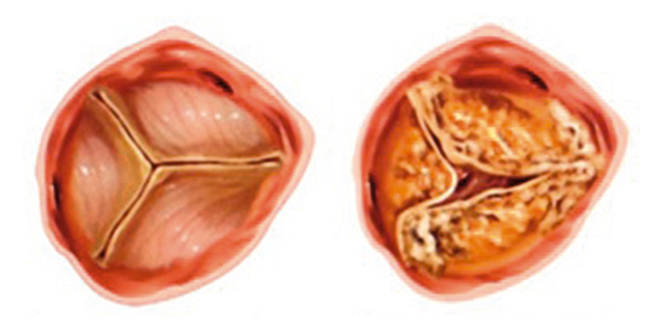 K L I N I S C H E P R A K T I J K a FIGUUR 1 Illustratie van (a) een normale aortaklep en (b) een verkalkte aortaklep (bron: www.brusselsheartcenter.