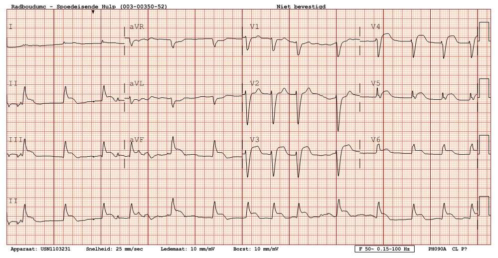 ECG